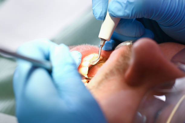 Best Emergency Treatment for Dental Infections or Abscesses in Rosemount, OH