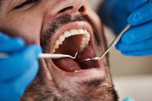 Best Emergency Tooth Extraction in Rosemount, OH