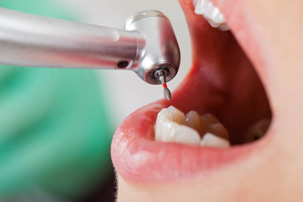 Best Emergency Dental Care for Broken or Chipped Teeth in Rosemount, OH